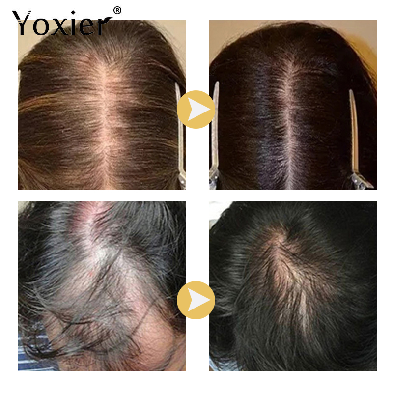 Intensive Wachstum Serum Verhi – Hair Care Spray Bewertung und Preis